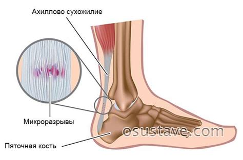 Тендинит ахиллова сухожилия
