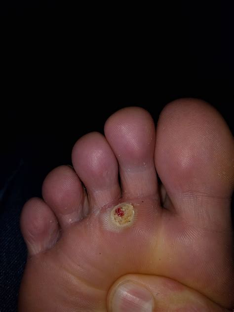 Wtf is on my foot. I thought it was a corn but now I doubt it. Story