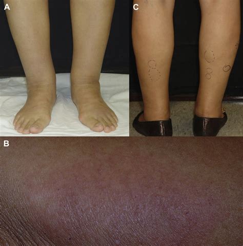 (A) Initial edema and ankle swelling on both lower legs. (B) Indurated ...