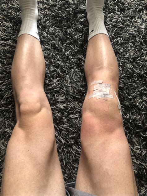 11 days post op, is my quad looking good atrophy wise? : r/ACL