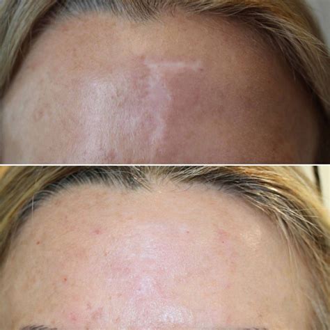 Scar Camouflage Services Los Angeles - Luna Skin Solution