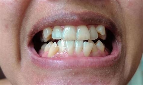 Bad Teeth Stock Photos, Images and Backgrounds for Free Download