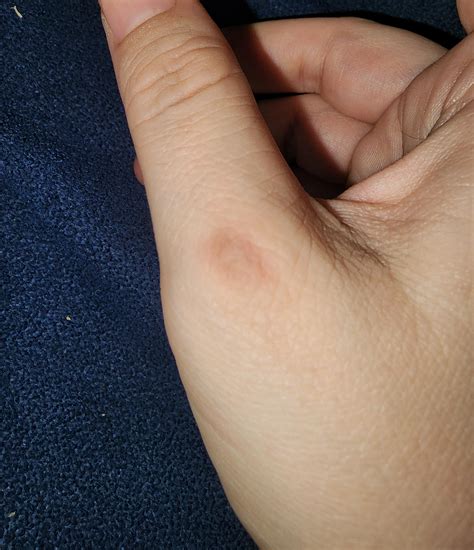 Painful and itchy lump. : r/medical_advice