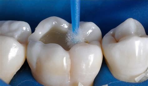 Реставрация зубов, восстановление зуба Раменское - «New Smile»