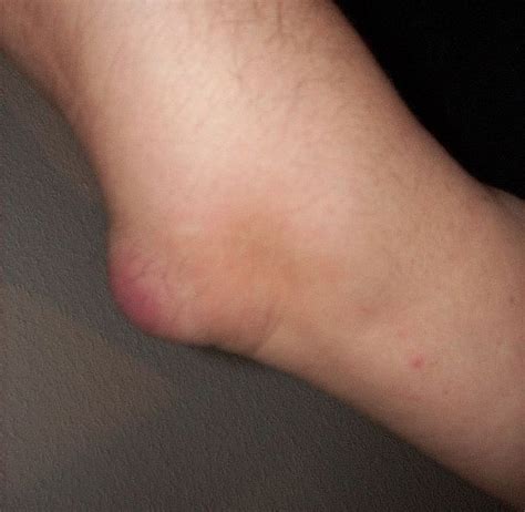A Swollen Elbow: Olecranon Bursitis | CoreWalking