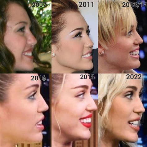 Miley Cyrus Plastic Surgery: A Comprehensive Look