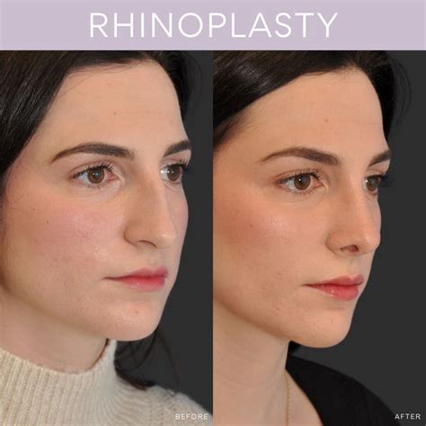 rhinoplasty    artofit