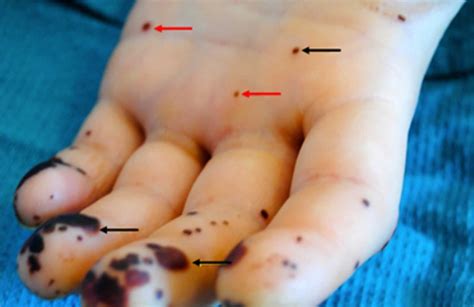 Osler nodes, Janeway lesions & splinter hemorrhages