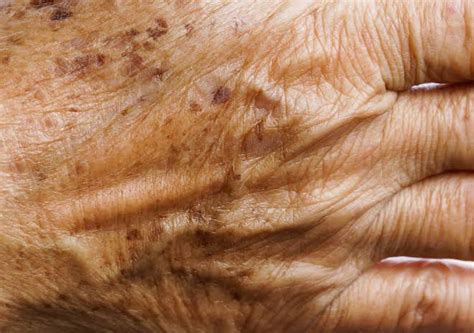 Mancha Escura Nos Dedos - Por que temos manchas escuras no dorso das mãos? | Dermatolaser