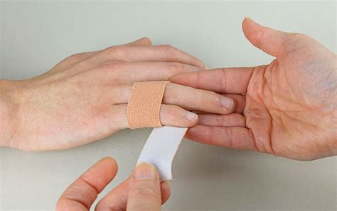 Sprained Pinky Finger Cast | edu.svet.gob.gt