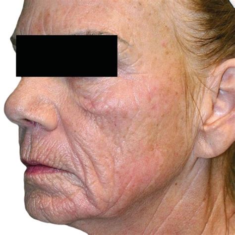 Non-Invasive Wrinkle Reduction Treatments | Venus Treatments