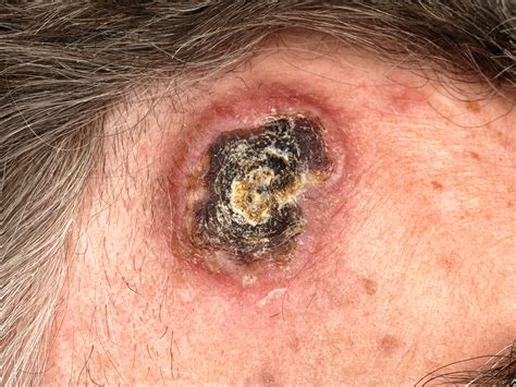 Lymphomatoid Granulomatosis Skin EP14.03 10 Ebstein Barr