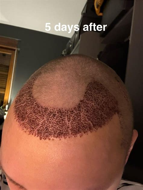 10 days after hair transplant 3