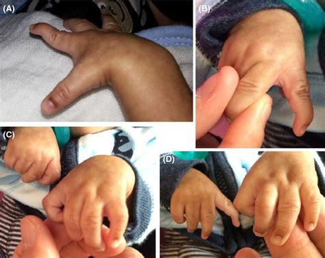 2q31.1 microdeletion syndrome: case report and literature review ...