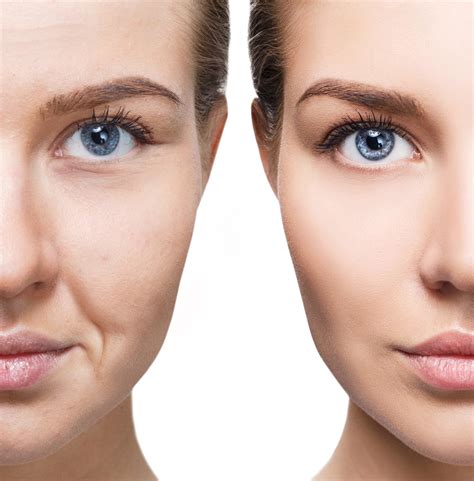 The Benefits of getting Botox in South Korea | Seoul Cosmetic Surgery