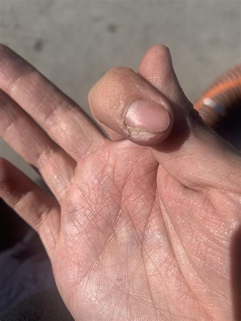 Infected nail : r/DiagnoseMe
