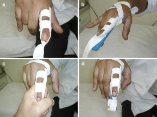 The use of traction splint in the management of phalangeal fractures of ...