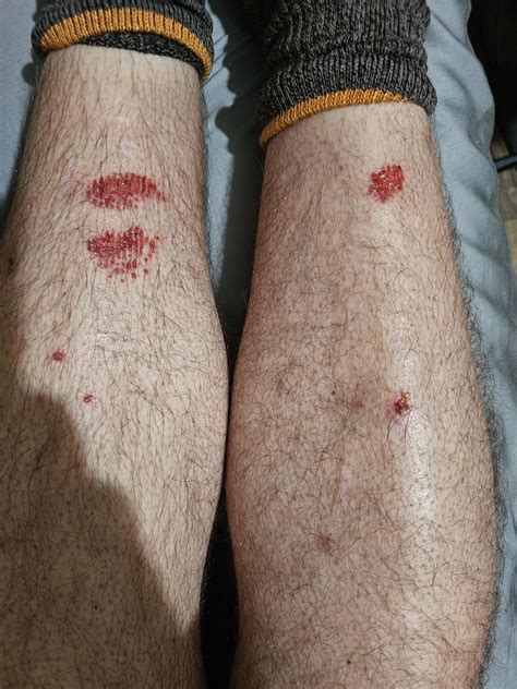 Got my shins destroyed by some hot dip galvanized steel bar today : r