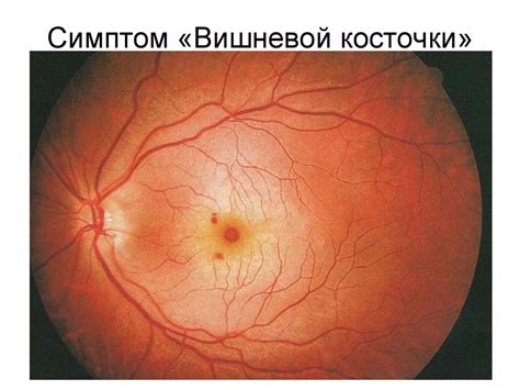 Что такое сосудистая дистония сетчатки - фото презентация