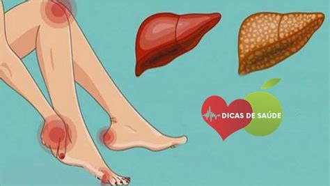 O Que Causa Dor No Figado - Gordura No Figado Causa Dor – Gordura no fígado: o que é, sintomas e ...