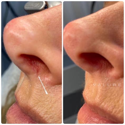 Laser Spider Vein Removal