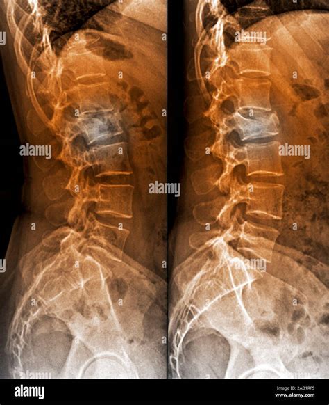 Untreated fractured vertebra. Coloured X-rays of sections through the ...