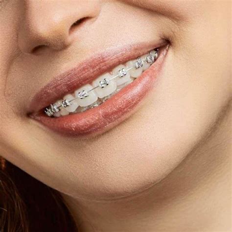 ceramic braces  top metal  bottom