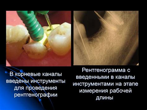 Формирование первичного эндодонтического доступа. Рабочая длина канала ...