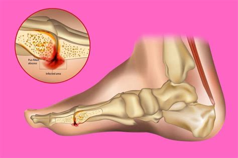 Toe Bone Infection + Non-Surgery Options