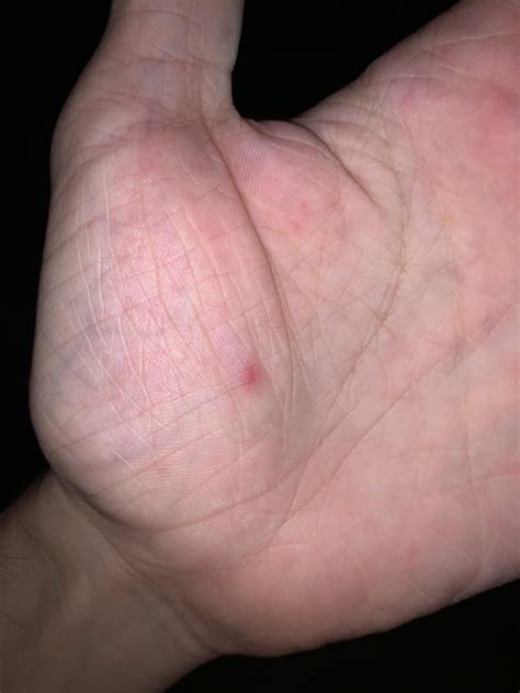 Herpetic whitlow or dyshidrotic eczema? : r/DiagnoseMe