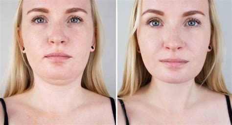 facelift  chin liposuction  omaha ne
