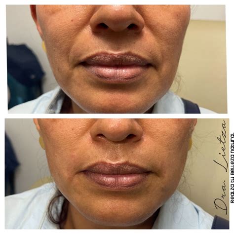 Resultados Antes y Después de Rellenos Faciales con Ácido Hialurónico