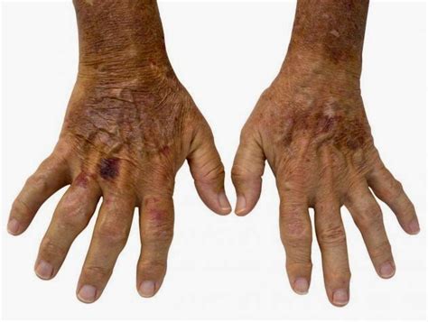 TU SALUD Y LA NUTRICIÓN.: LA ESCLERODERMIA.