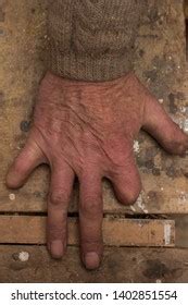 missing fingers images stock  vectors shutterstock