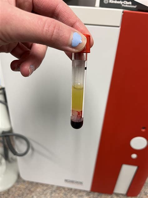 Has anyone seen this before? Icteric serum that is a jello like