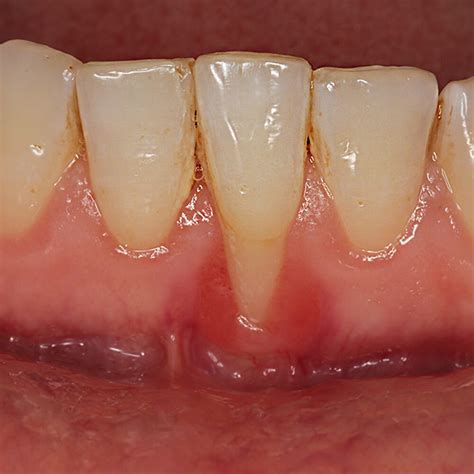 Gingival recession – Gum retraction - CABINET STOMATOLOGIC