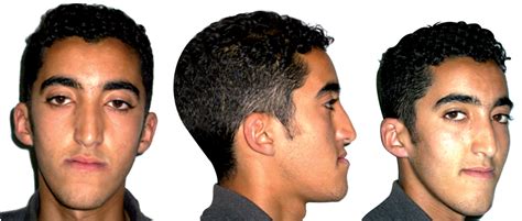 Long Face Syndrome Surgery Before And After