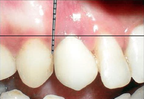 papillary height measurement  baseline figure  papillary height