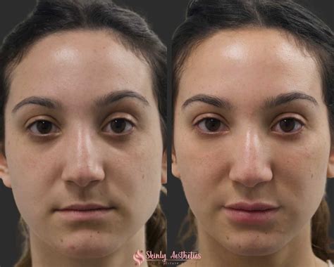 Under Eye Fillers - Before & After Results at Skinly