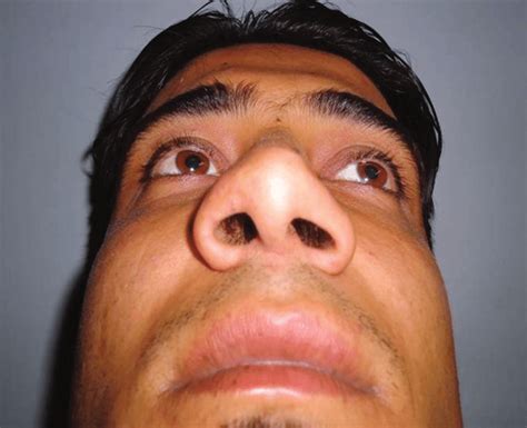 Alar base excision for alar flaring, preoperative (left), and the ...