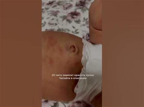 Пуповина отваливается сама на 7-10 день после родов.Акушерка пупок не ...