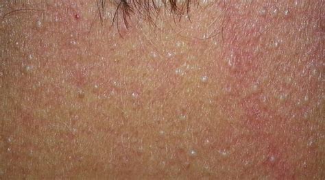 Definition of fibrofolliculoma - NCI Dictionary of Genetics Terms - NCI