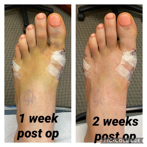 I wanted to add photos of before and after post op bilateral