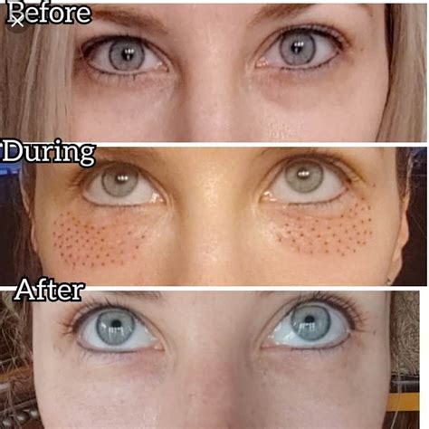 Plasma Pen Fibroblast Skin Treatment in Plano TX | Beauti Science Med Spa