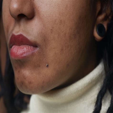 how to get rid of dark spots from acne 11
