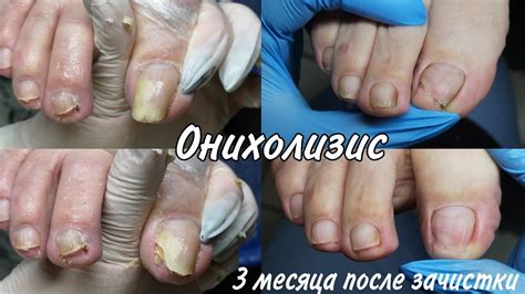Лечение, зачистка, онихолизиса, отслоение ногтей, аппаратный педикюр и ...