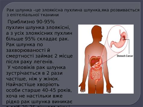 Рак шлунка - презентация онлайн