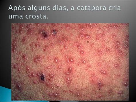 Quanto Tempo Dura A Catapora - Catapora slide tarba