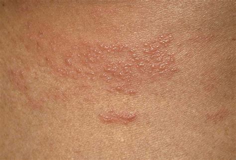 Burning Pain With a Spreading Rash and Blisters: Case Quiz