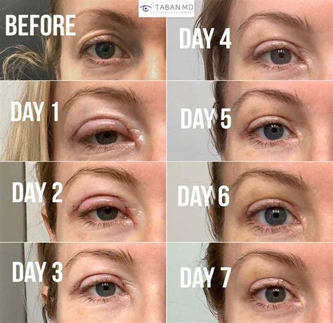 What is blepharoplasty, the celebrity-loved cosmetic surgery procedure